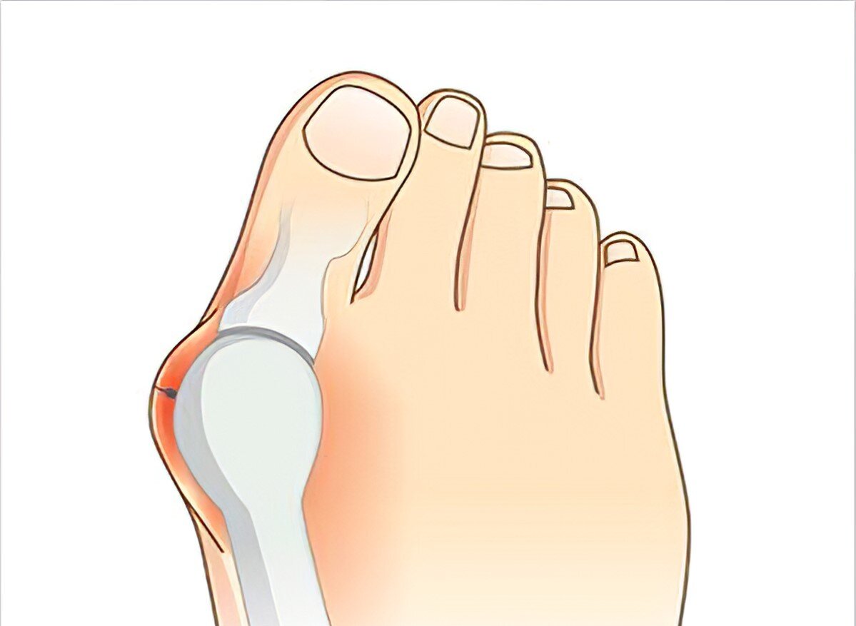 Косточка на ноге (Hallux valgus) - одна из самых частых причин обращения к подиатру