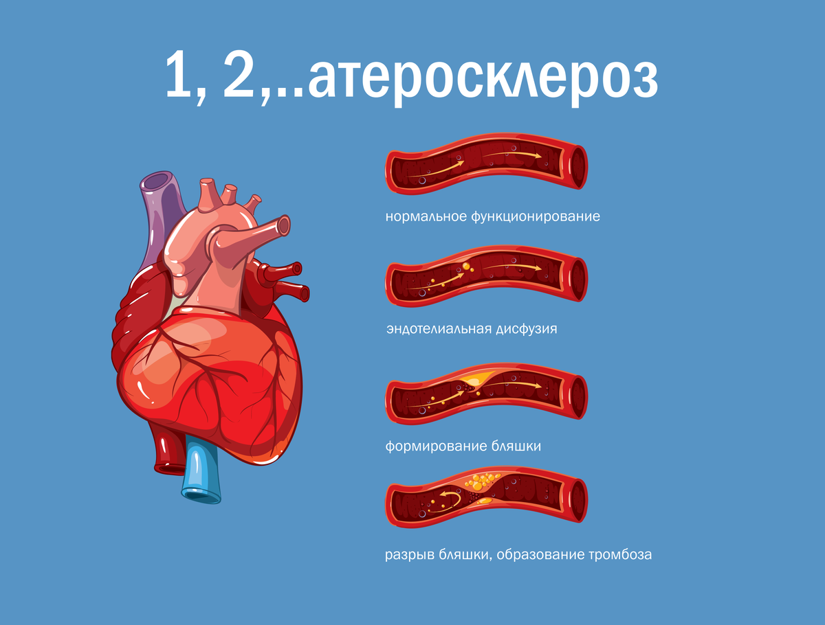 Атеросклероз: кто в зоне риска? | Скандинавский Центр Здоровья | Дзен