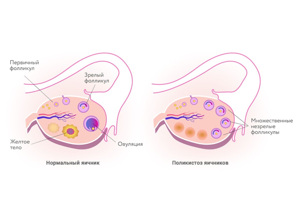 СПКЯ, или синдром поликистозных яичников | Цитамины. Пептидные  биорегуляторы | Дзен