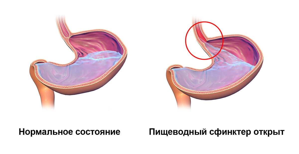 Желудочно-пищеводный рефлюкс. Гастроезофагеальна рефлюксна хвороба.