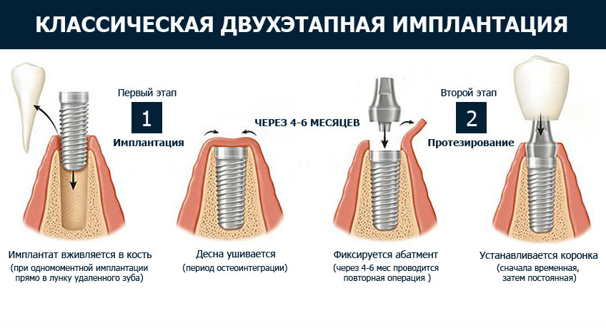 Из чего состоит имплант зуба схема