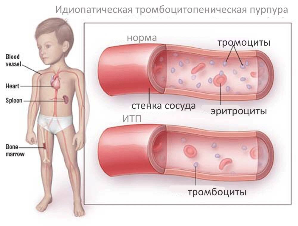 Тромбоцитопеническая пурпура клиническая картина