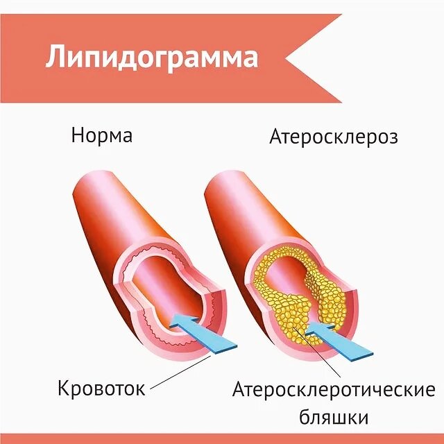 Что входит в липидограмму