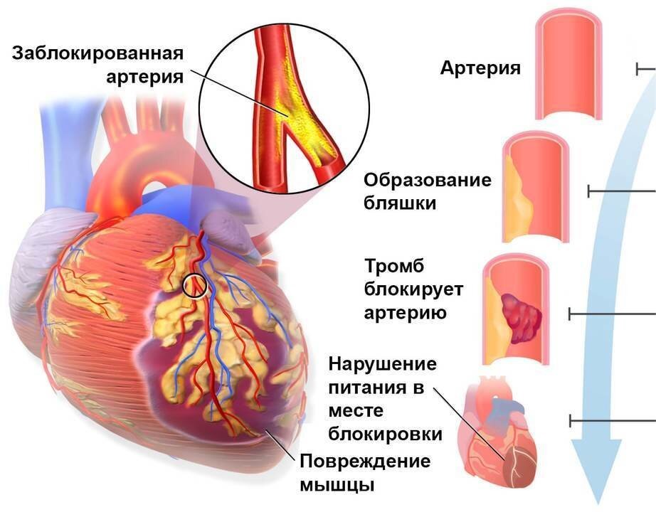 рис.2. Атеросклероз коронарных артерий