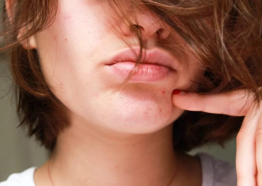 Прыщи на лице — причины, виды, диагностика и лечение