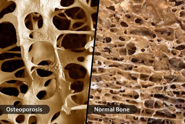 1) Остеопороз и 2) Нормальная кость
