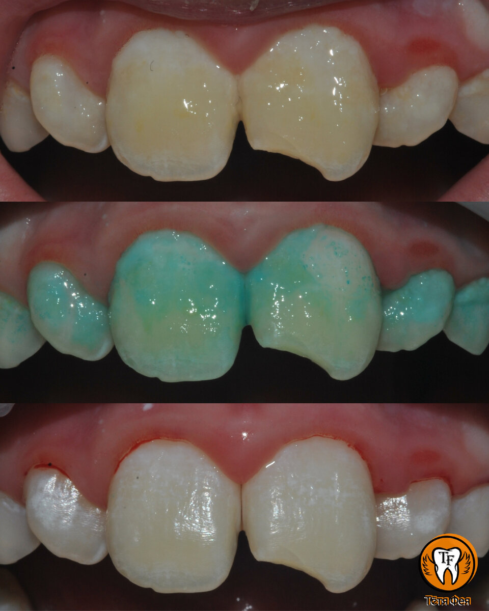 На фотографиях постоянные зубы покрыты "махровым" зубным налëтом, который перед проведением гигиены окрашен специальным красителем.