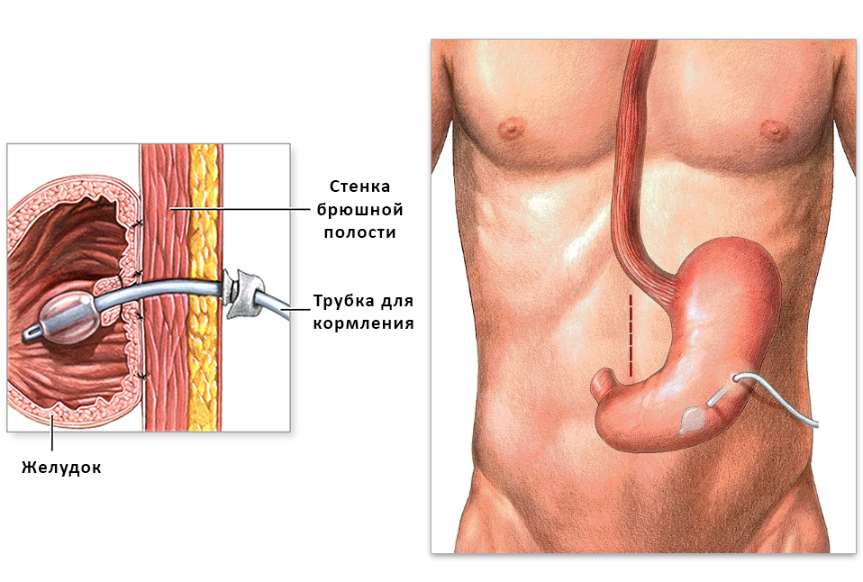 Гастростома свищ желудка. Строение трубки гастростомы. Эндоскопическая гастростома. Трубчатая гастростома.