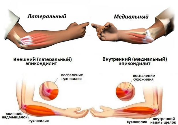 Медиальный и латеральный эпикондилиты