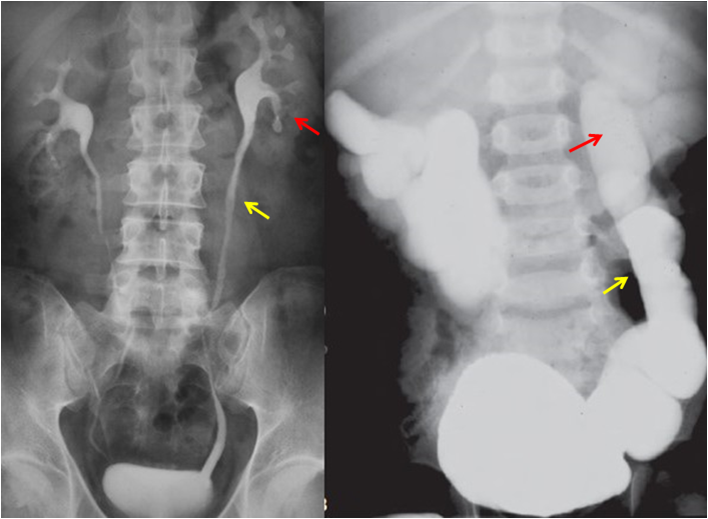 На рисунке справа расширение мочеточников и почек говорит о том, что моча не может адекватно выводиться из-за препятствия. Расширение - высокое давление в мочевыводящих путях. Почкам очень плохо. 