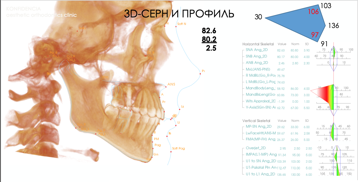 3Д-цефалометрия на этапе диагностики