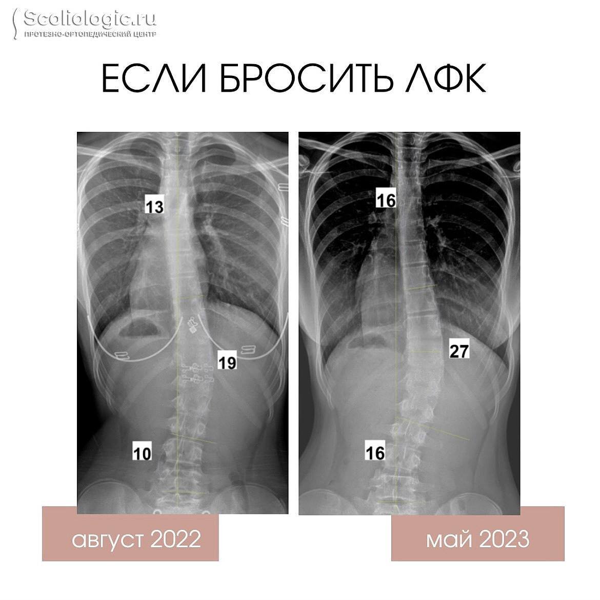 План конспект сколиоз лфк