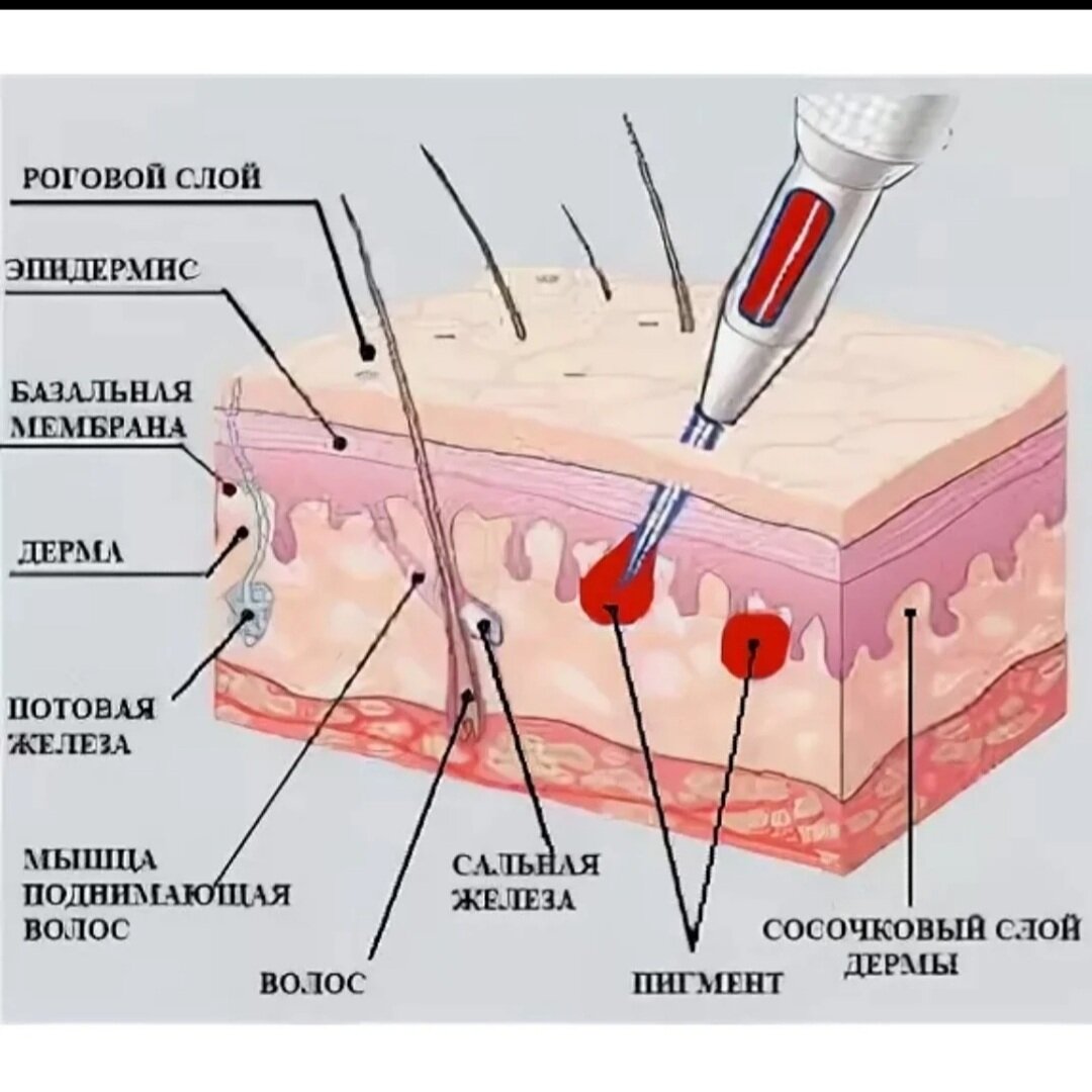 Введение пигмента в слои кожи