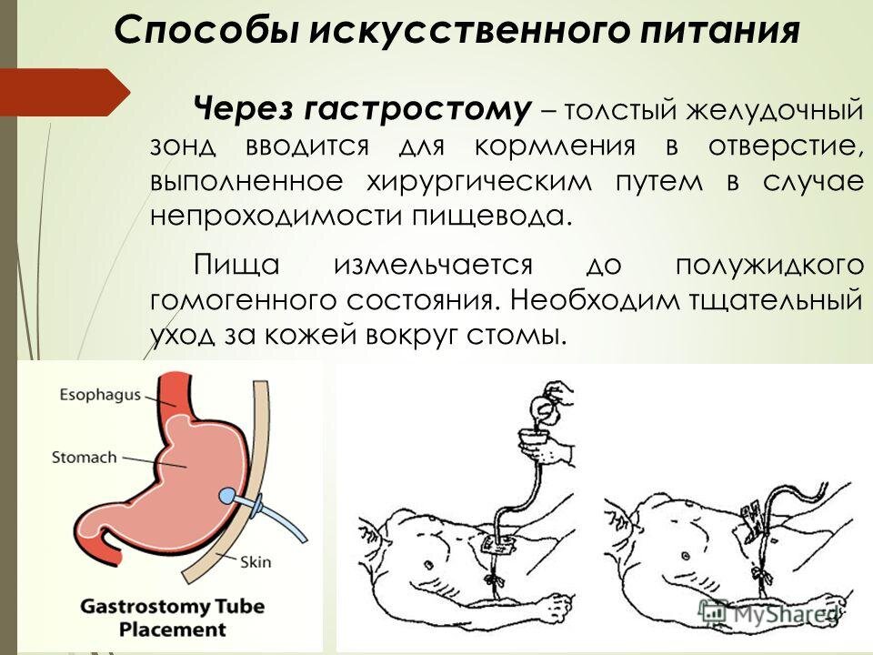 зонд назогастральный двухканальный. Integral зонд питательный назогастральный 6. зонд для питания через гастростому. зонд питательный -сн 6, 40см. Braun nutritub gastral 9246533.