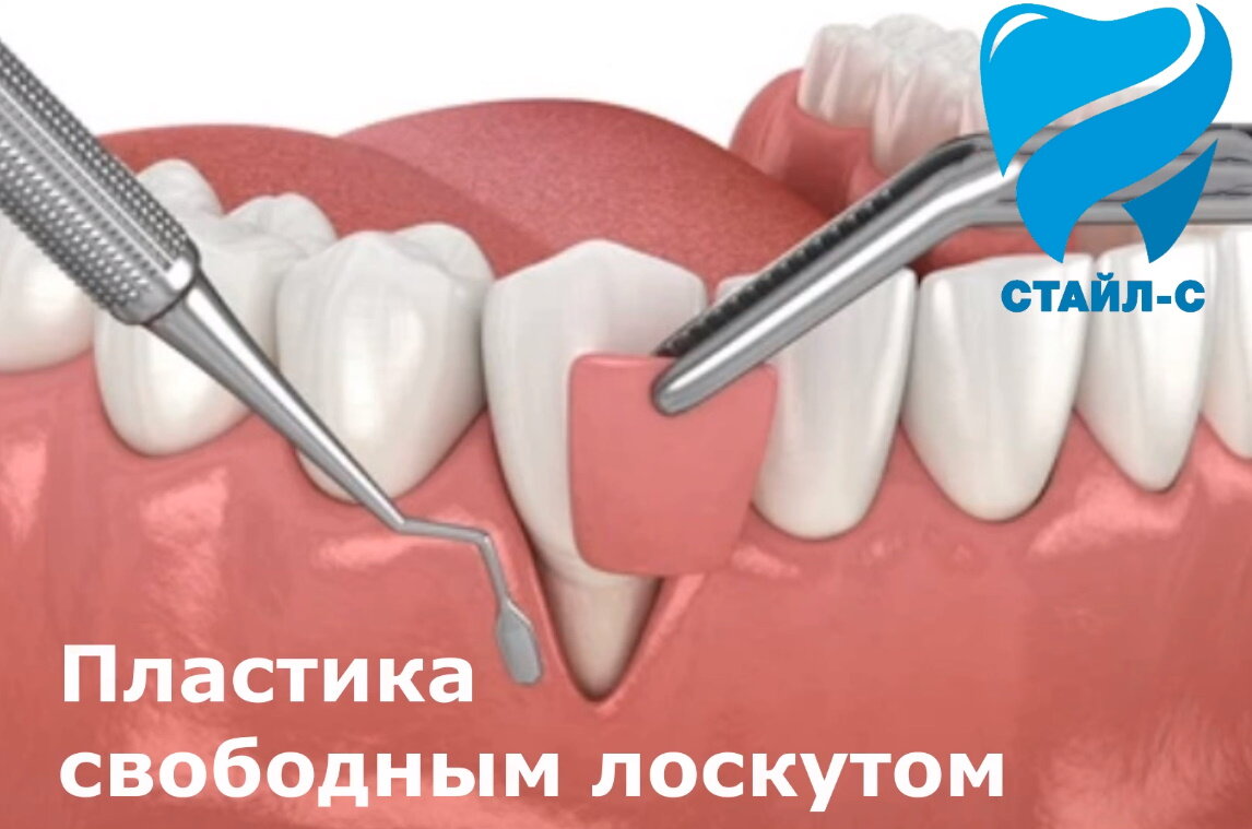 Один из вариантов хирургического лечения рецессии десны.