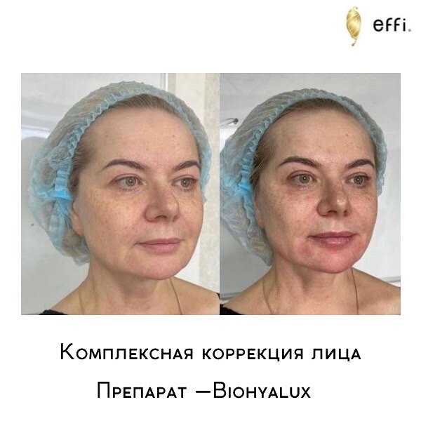 Клиника косметологии и пластической хирургии effi. Красноярск. Препарат Biohyalux Fine lines 