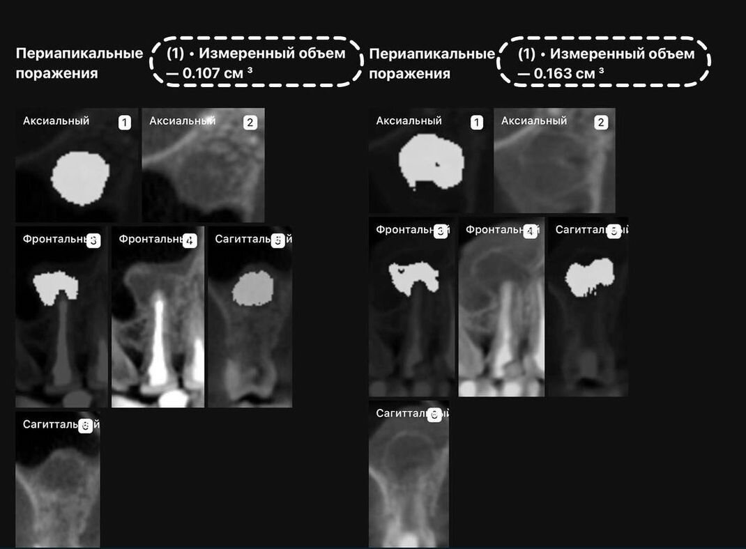 Случай из практики: сильно разрушенные зубы с периодонтитом ...