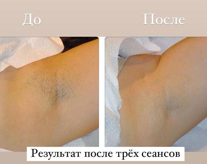 Лазерное удаление волос до после Клубничная кожа - что это? Лазерная Эпиляция*Москва Дзен