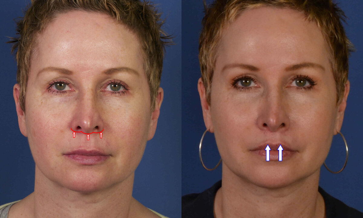 операция булхорн фото до и после