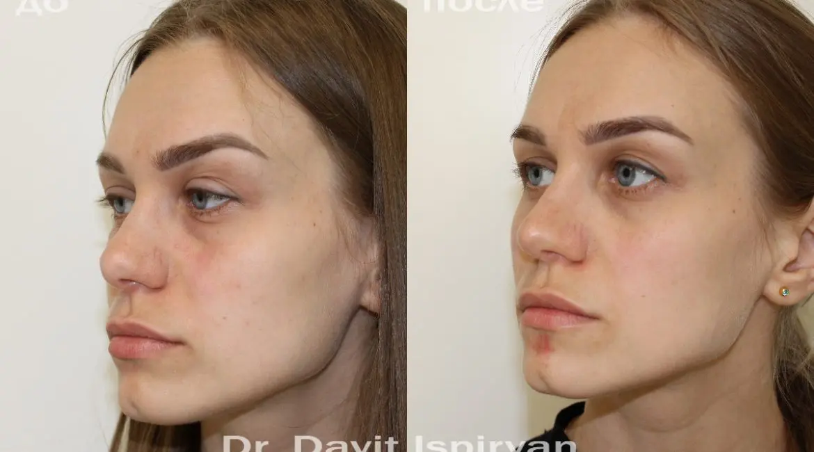 Вторичная ринопластика фото до и после. Фото с сайта пластического хирурга Давита Испиряна. Имеются противопоказания, требуется консультация специалиста