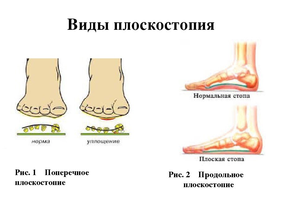 Виды плоскостопия