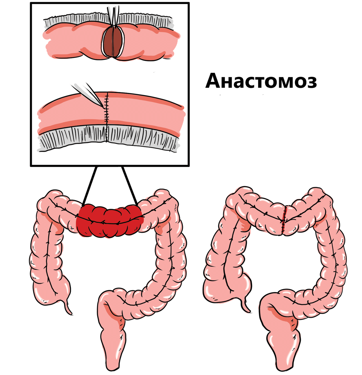 Операции на кишечнике какие. Виды операций на кишечнике. Операция на кишечнике фото.