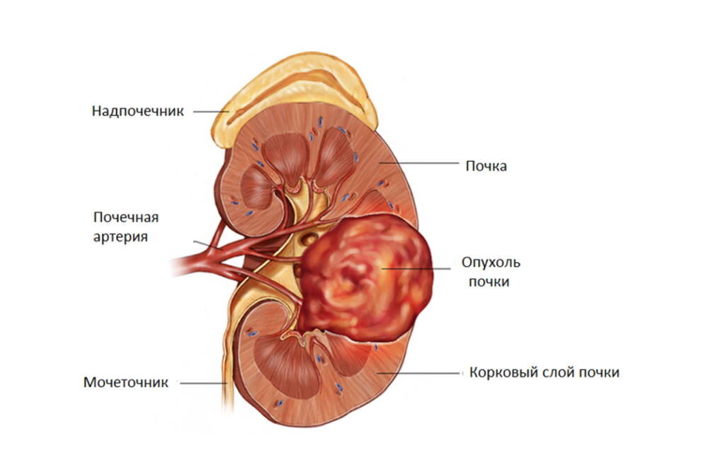 Онкология почки