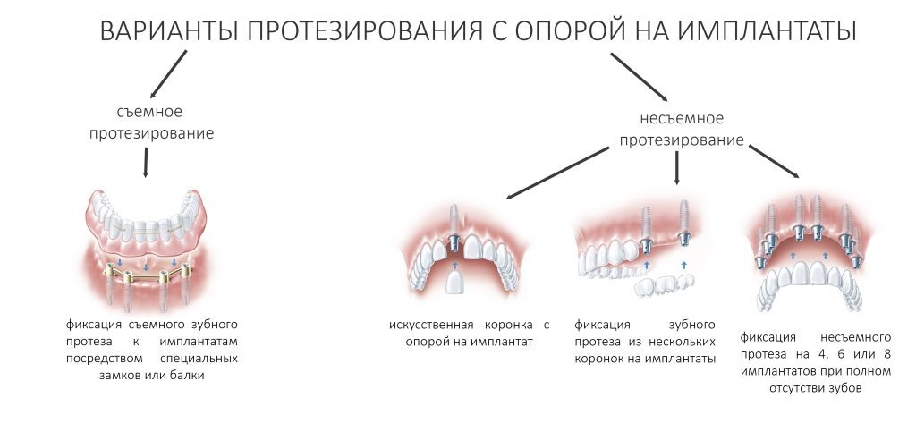 В отличие от других клинических ситуаций, отсутствие зубов на челюсти даёт довольно широкий простор для творчества. Мы видим множество решений, предлагаемых различными клиниками. В общих чертах, как уже упоминалось ранее, его можно разделить на съёмное и несъёмное. В свою очередь, съемное протезирование делится на два вида, замковая фиксация съемного протеза на специальных абатментах и использование для его опоры специальной балки (или балок):