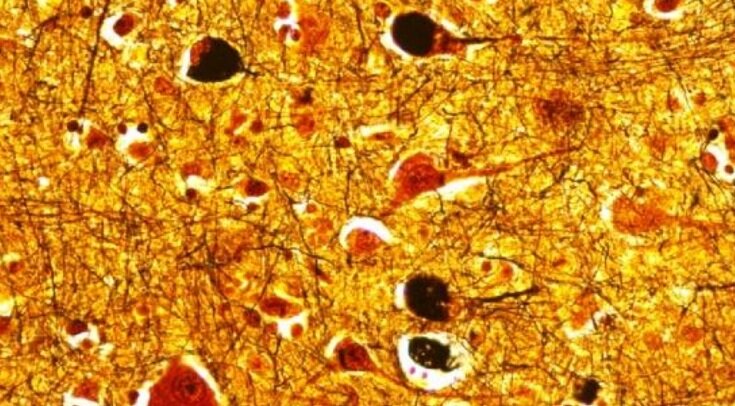     Отложения бета-амилоида при болезни Альцгеймера Anthony J. Intorcia et al. / bioRxiv, 2018