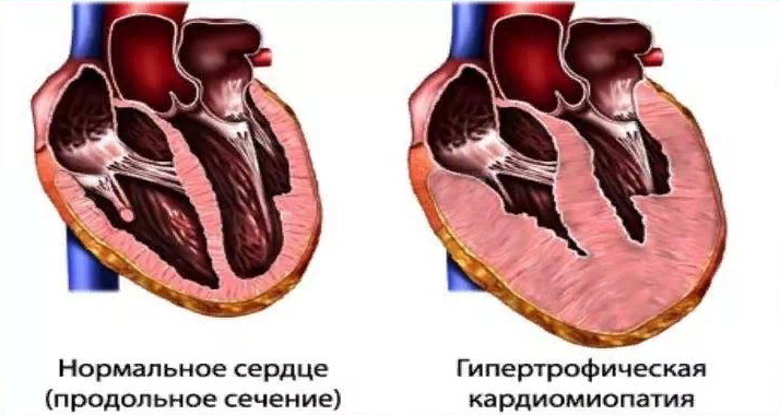 Кардиомиопатия у кошек