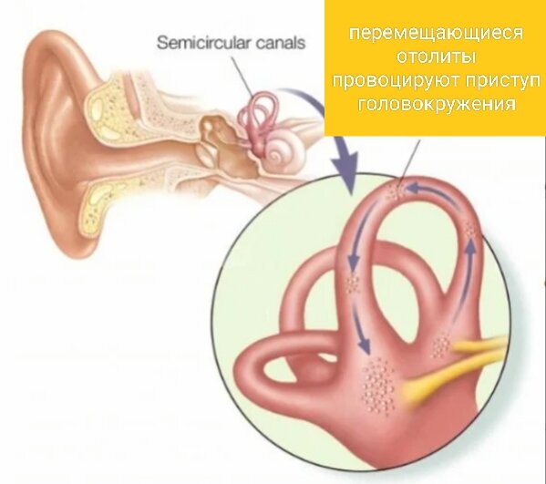 Головокружение из за внутреннего уха. Отолиты в ухе.