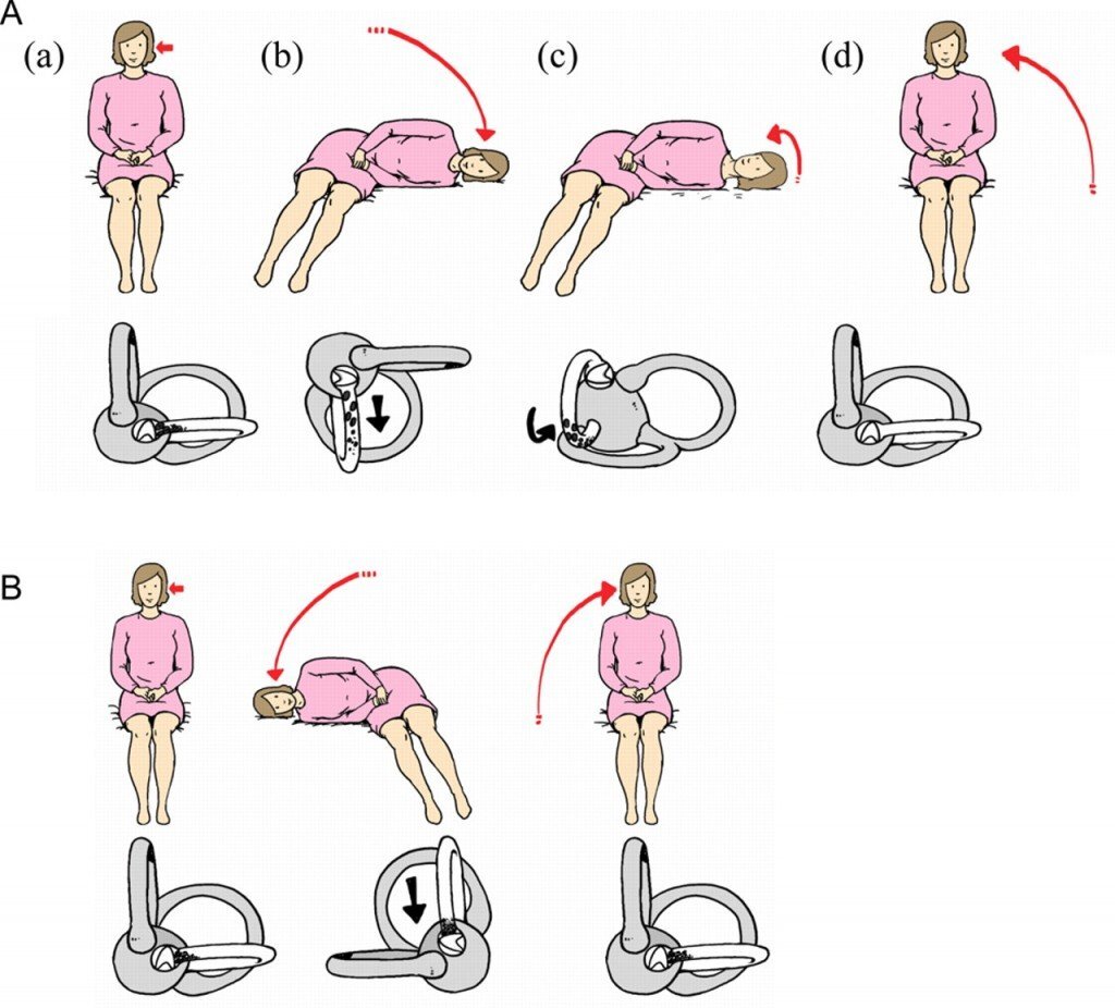 Гимнастика для вестибулярного аппарата при головокружении в картинках
