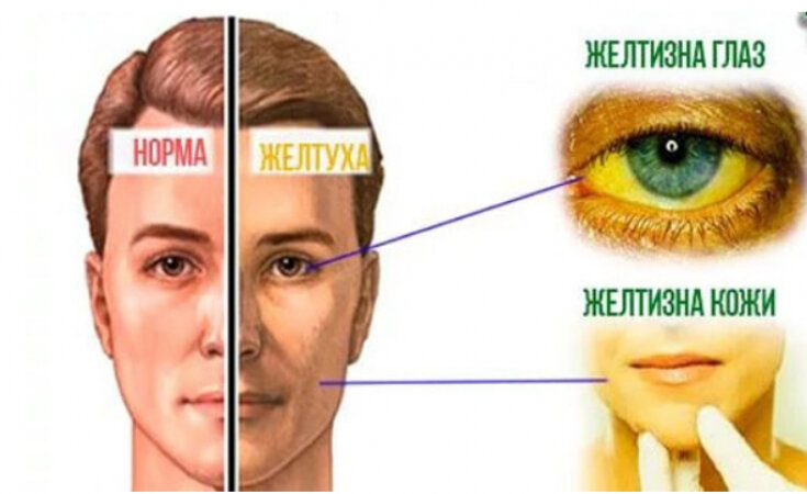 Желтые белки глаз: причины, лечение болезней печени