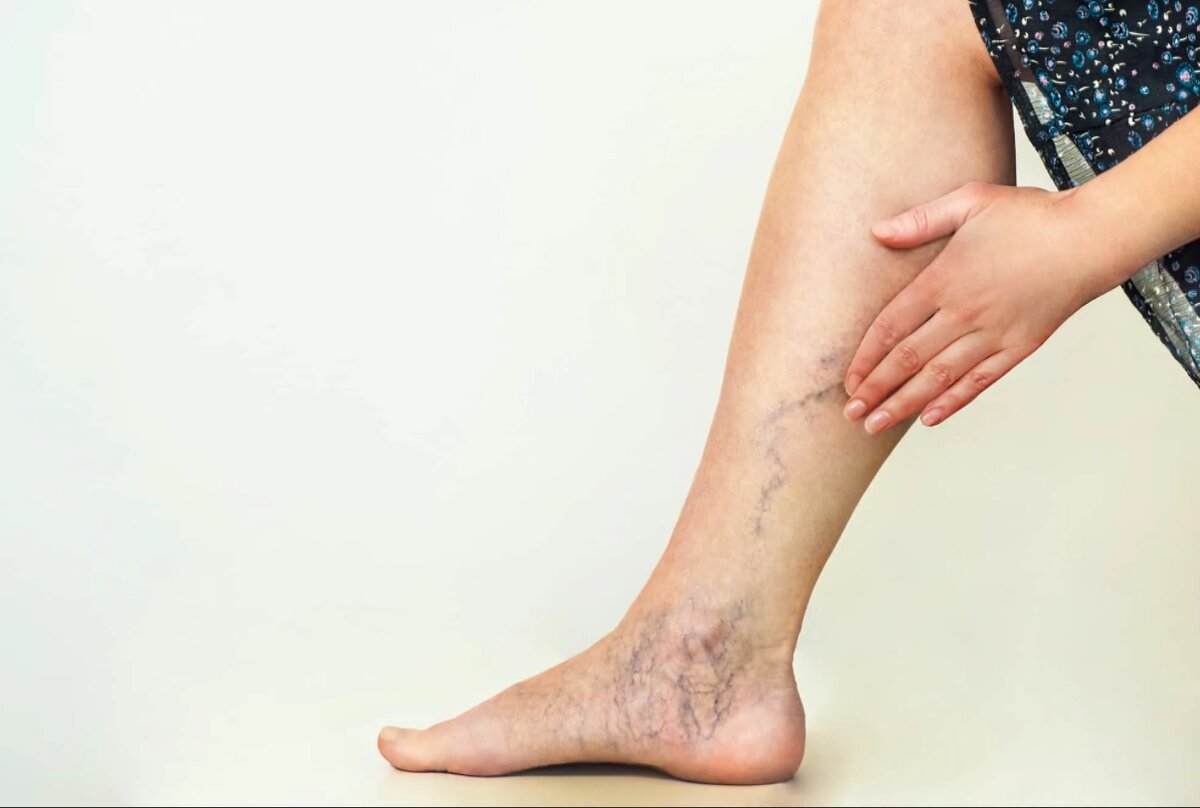 Как лечили варикоз в древности?