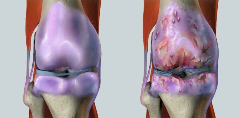 Гемартроз: почему надо не допустить осложнений?
