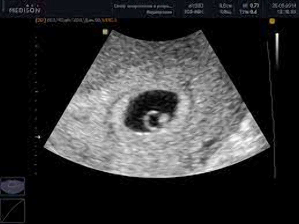 Так выглядит шестинедельный эмбрион на УЗИ