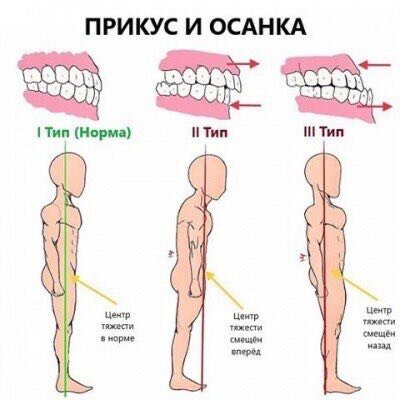 Неправильный прикус у ребенка - почему важно вовремя заметить и исправить?