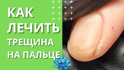 Трещина на ногте: причины, ремонт ногтя
