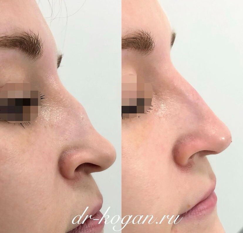 Коррекция носа филлером с использованием канюли. Фото предоставлено врачом дерматологом косметологом клиники Д.Р. Гришкяна - Коган Л.С. Имеются противопоказания, требуется консультация специалиста