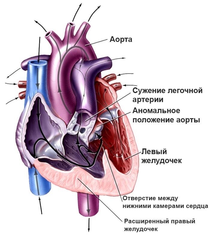 Аффективно-респираторный синдром у детей