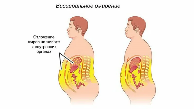 Жир в организме 1. Ожирение степень 1 степени у мужчин. Висцеральное ожирение 1 степени. Висцеральный и абдоминальный Тип ожирения. Ожирение 1 степени висцеральный Тип.