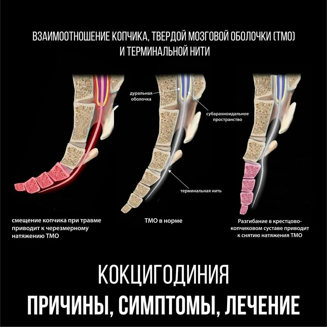 Ушиб поясницы при падении. Нормальное положение копчика. Перелом копчика кокцигодиния.