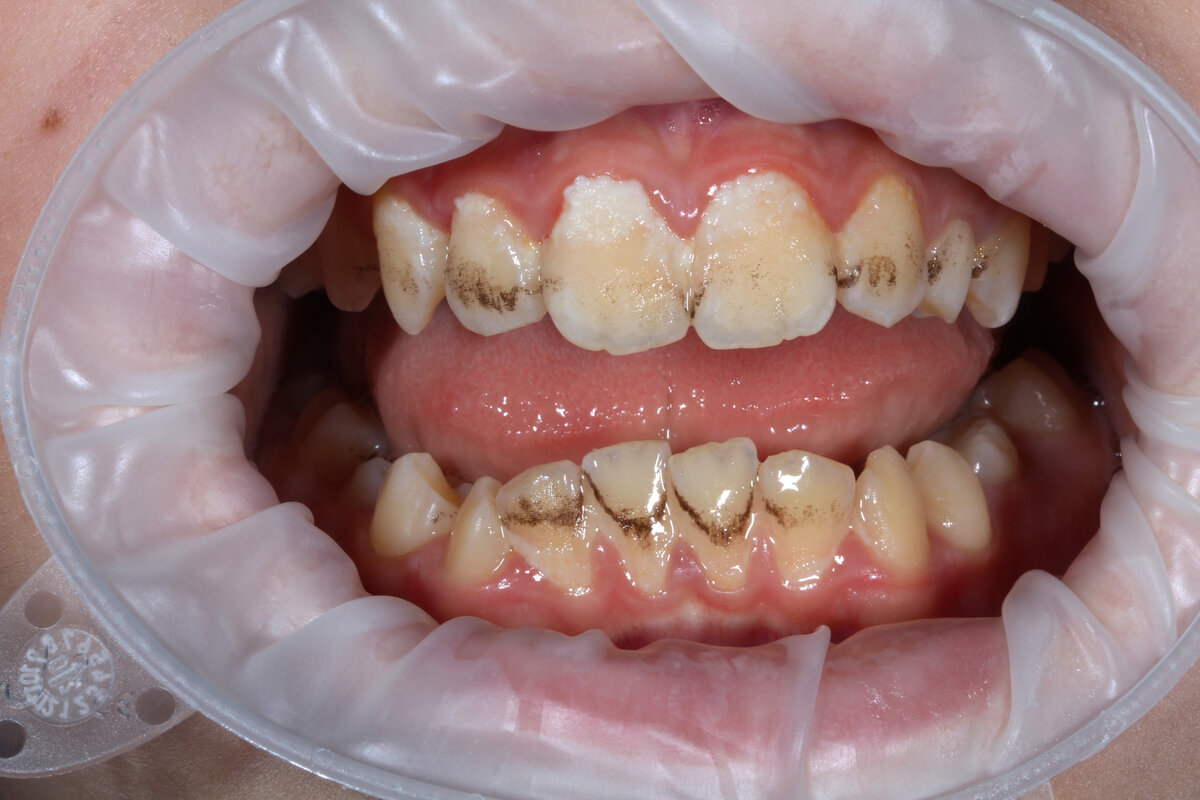 Налет Пристли на детских зубах