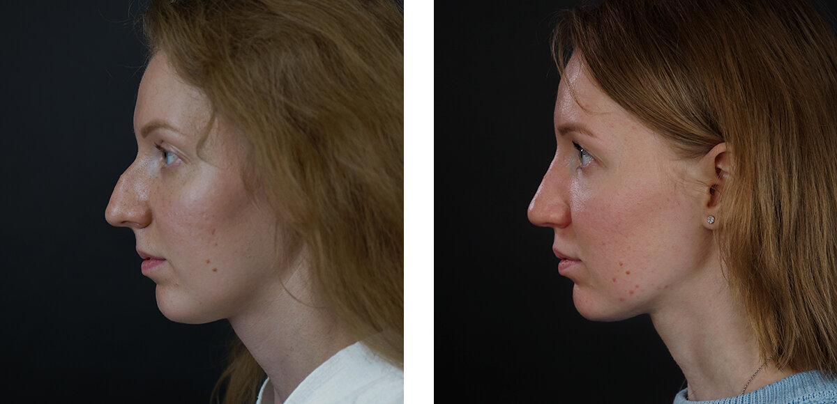 вольфганг губиш ринопластика. пластический хирург владивосток отзывы. тумаков глеб игоревич пластический хирург ринопластика. блефаропластика верхних век. сергей мошак.