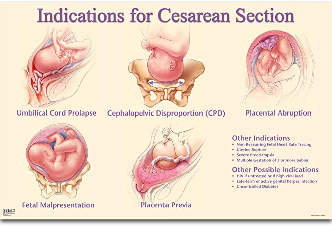 Кесарево сечение