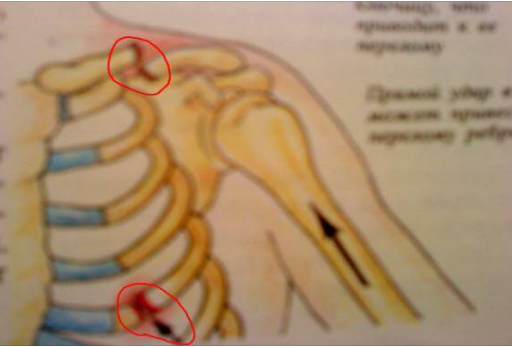 Мать ненормальная дзен канал. Перелом рёбер при прямом ударе. Перелом ключицы перелом ребра.