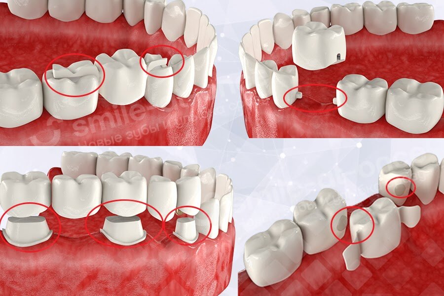 Типы зубных мостов и процедура их установки