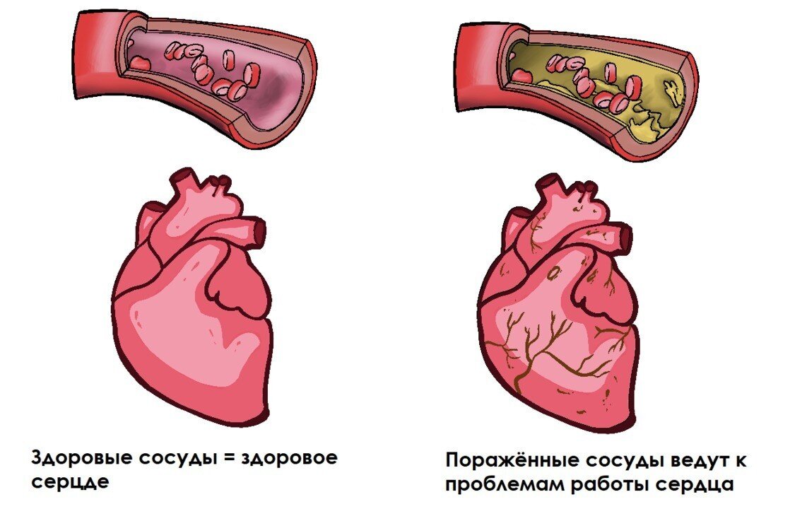 Атеросклероз. Фото: medportal.ru