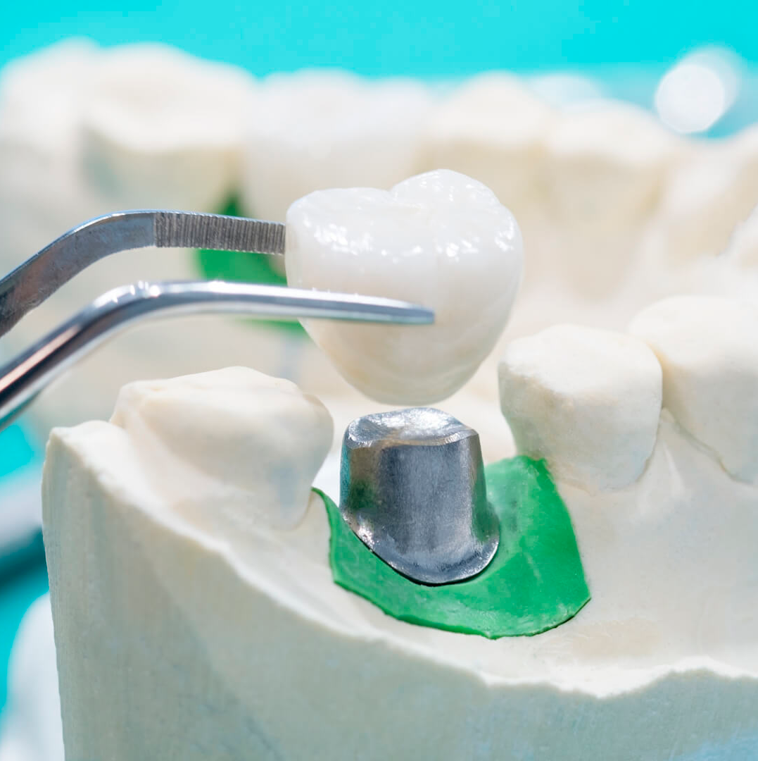 Купить материал для зубов. Зуб с короной. Стоматологические коронки. Стоматологические коронки на зубы.