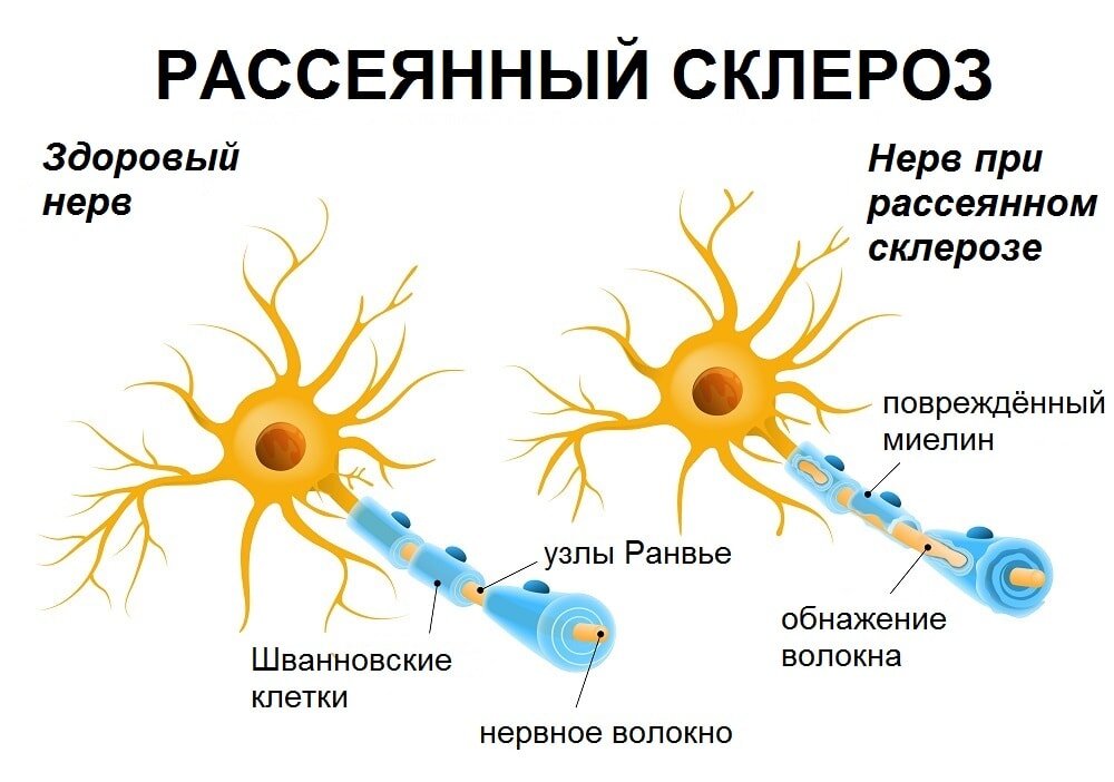 Рассеянный склероз: иммунная система против мозга